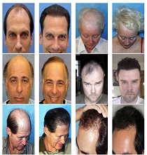 Restore Lost Hair Program