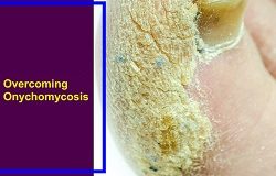 Overcoming Onychomycosis Scott Davis review